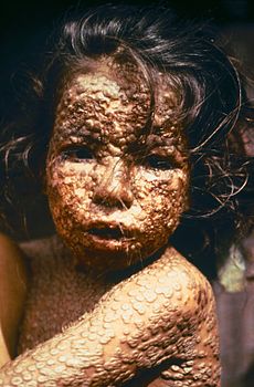 230px-Child_with_Smallpox_Bangladesh